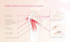 manual haluksy charakterystyka zmian