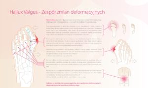 manual haluksy opis zmian